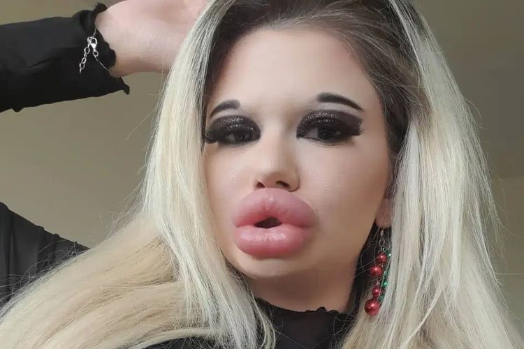 Andrea Ivanova (23) gadis asal Bulgaria yang terobsesi menjadi mirip Barbie, mengoperasi bibirnya sampai jadi paling dower sedunia.