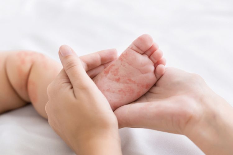 Dari Abad ke-9 hingga Kini, Campak Tetap Jadi Penyakit Paling Menular di Dunia