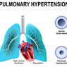 Hipertensi Pulmonal
