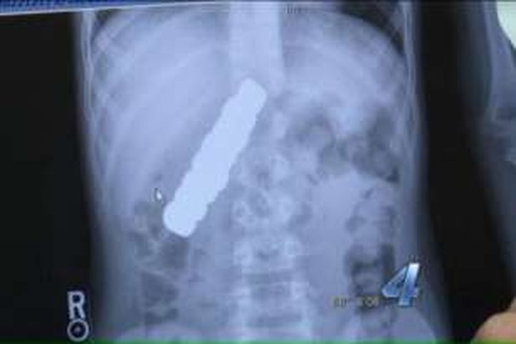 Delapan magnet di dalam perut seorang bocah berusia 10 tahun di Oklahoma City, AS.
