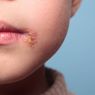 Mengenal Herpes: Jenis, Penyebab, Gejala, dan Pengobatannya