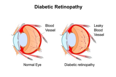 Retinopati Diabetik