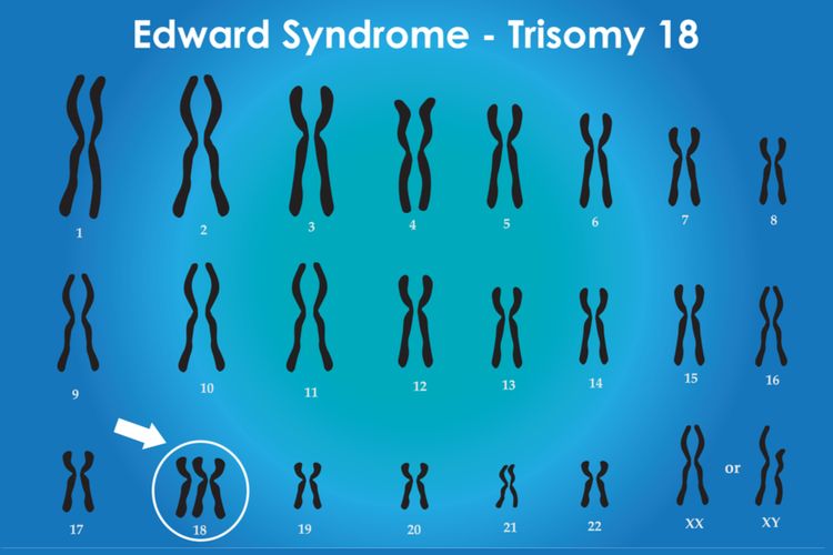 Ilustrasi trisomi 18 atau sindrom Edward