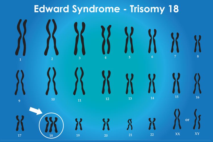 Mengenal Gejala Trisomy 18 Atau Edward Syndrome Riset 