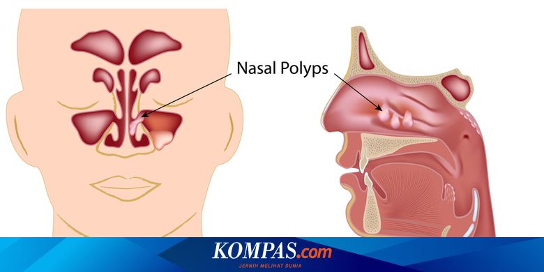 Penyakit Polip Hidung Gejala Penyebab Pengobatan Kompas Com