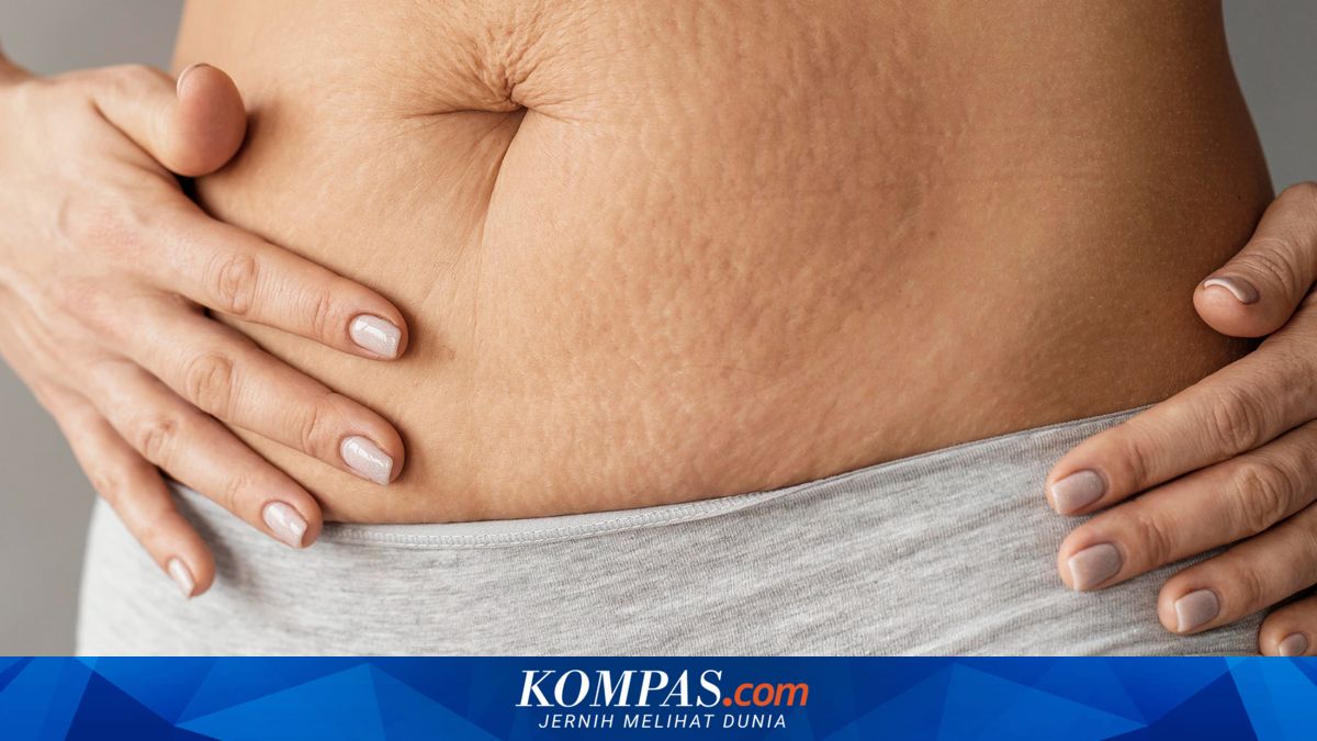 7 Cara Alami Hilangkan Stretch Mark, Pakai Minyak Bulus?