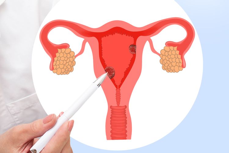 Ilustrasi polip rahim, gejala polip rahim, penyebab polip rahim, apakah polip rahim bisa sembuh sendiri, perbedaan polip dan miom di rahim, polip rahim bahaya atau tidak.  