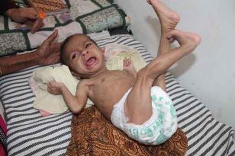 Bayi Margaretha Amfotis (8 Bulan), hanya memiliki berat badan 4 kilogram saja sehingga oleh Dinas Kesehatan Kabupaten Timor Tengah Utara (TTU), NTT, Margaretha mmasuk kategori gizi buruk.