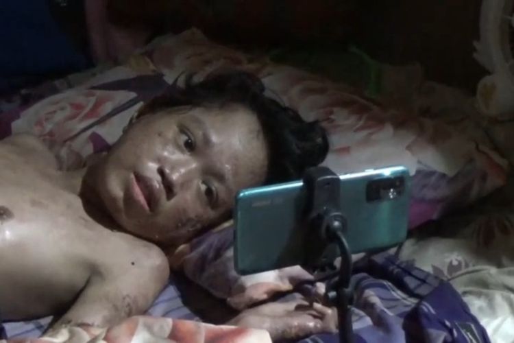 Kisah Zulkifli di Polewali Mandar: Digigit Anjing Saat SMP, Terbaring Sakit Bertahun-tahun, Ibunya Bertahan dengan Mencari Kelapa