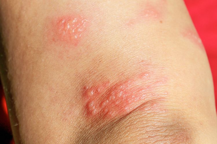 Ilustrasi ruam lepuh di kulit tangan. Beberapa masalah kulit bisa muncul sebagai tanda penyakit autoimun, seperti ruam, lepuh, dan bersisik.
