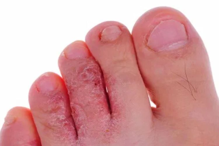 Ilustrasi kutu air. Apakah Anda penderita diabetes? Penderita diabetes rentan mengalami masalah kaki, seperti kutu air (athlete's foot) dan infeksi jamur pada kuku.