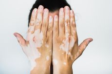 Kenali Apa Itu Vitiligo, Penyebab, dan Tanda-tandanya