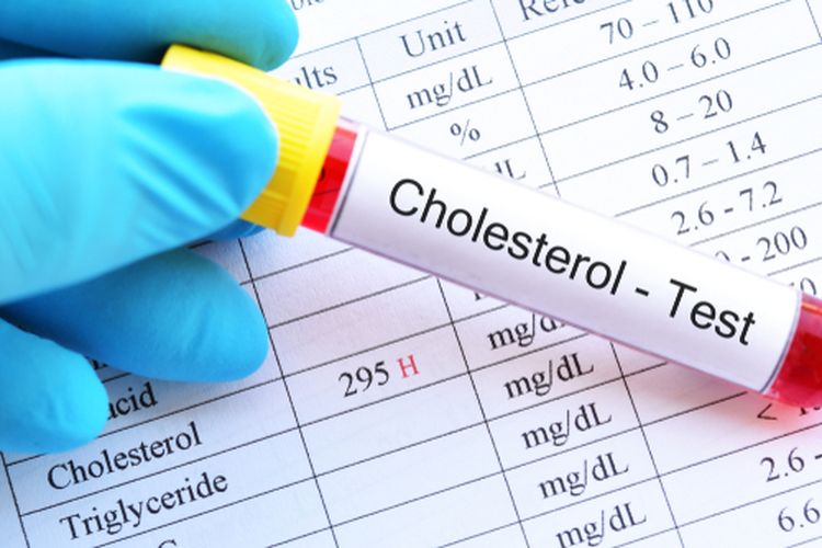 Kolesterol tinggi adalah salah satu faktor yang dapat menyebabkan penyakit jantung. Berawal dari pembentukan plak di pembuluh darah.