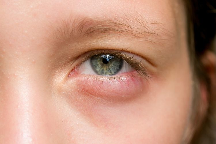 Masalah kesehatan tertentu bisa jadi alasan kenapa ada lendir seperti benang di mata.