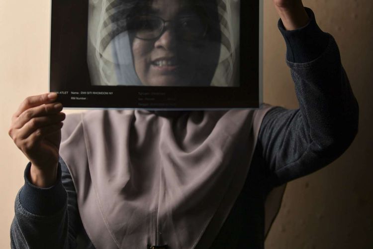 Dwieky Siti Rhomdoni (37) menunjukkan hasil rontgen paru-paru miliknya di Jakarta. Dwieky merupakan pasien PDP yang menjalani isolasi di RS Darurat Wisma Atlet Jakarta.