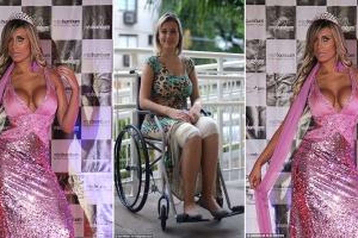 Ratu Kecantikan asal Brasil, Andressa Urach (27) menderita kelumpuhan setelah menjalani operasi plastik untuk pengencangan paha