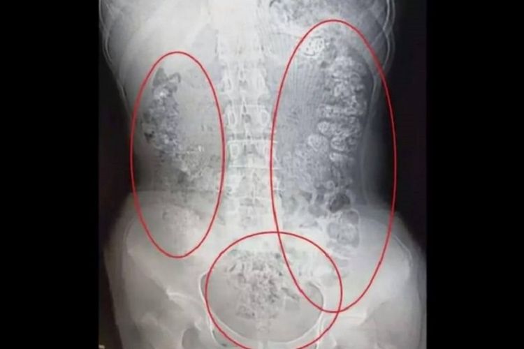 Pemindaian CT menunjukkan bola mutiara dalam bubble tea terlihat di perut seorang gadis di China yang mengalami sembelit selama lima hari.