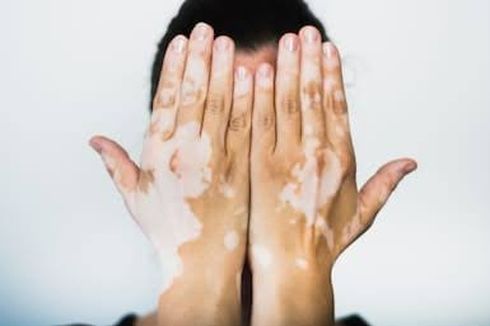 Waspada Vitiligo, Kelainan Pigmen Warna pada Kulit