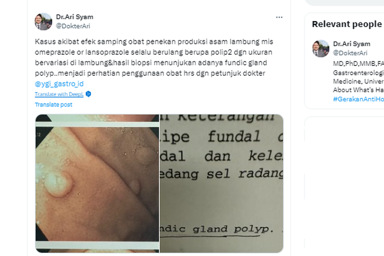 Minum Omeprazole dan Lansoprazole Bisa Picu Polip Lambung, Ini Penjelasan Guru Besar UI
