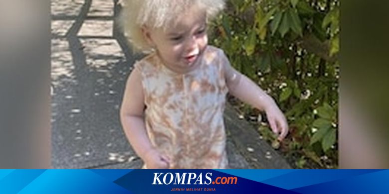 Punya Rambut Tak Bisa Disisir, Bayi di Inggris Dijuluki Albert Einstein Kecil