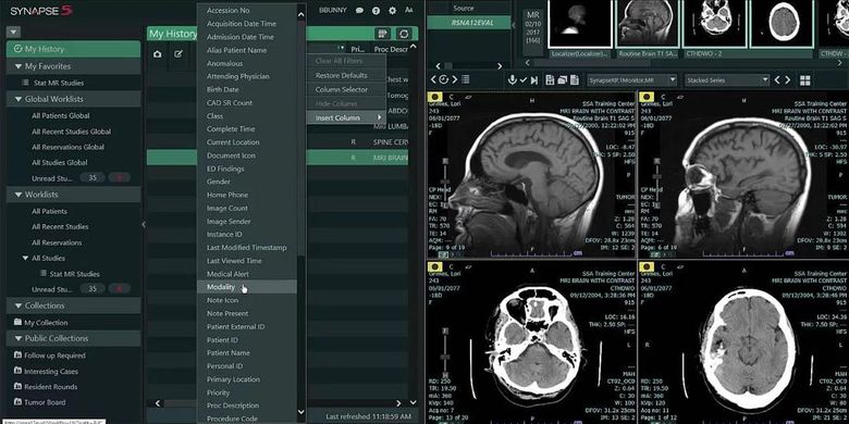 Ilustrasi hasil pemindaian otak pasien stroke dengan teknologi terkini di RS PON.