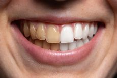 7 Cara Memutihkan Gigi Kuning secara Alami