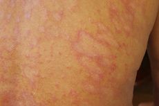 Tinea Corporis