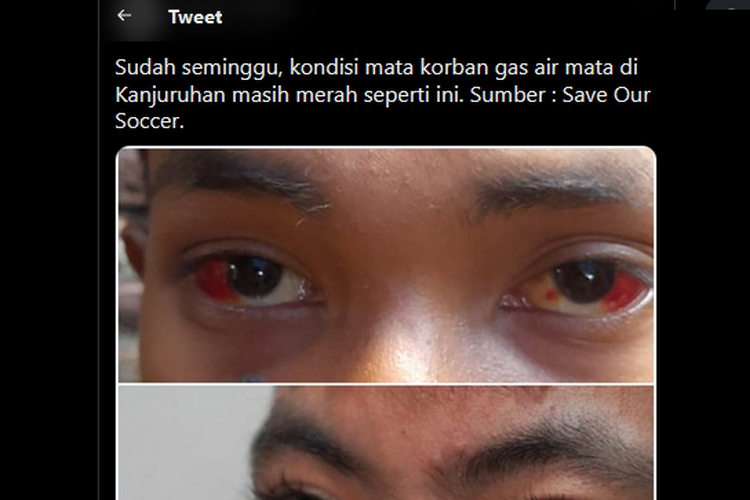 korban kanjuruhan alami luka di bagian mata, apakah bisa sembuh?