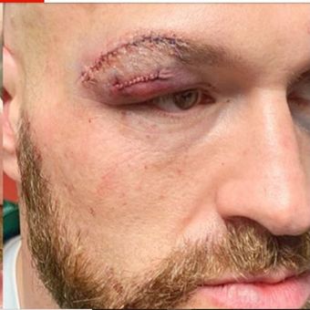 Bekas jahitan pada pelipis Tyson Fury.