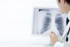 8 Mitos dan Fakta tentang Kanker Paru-paru