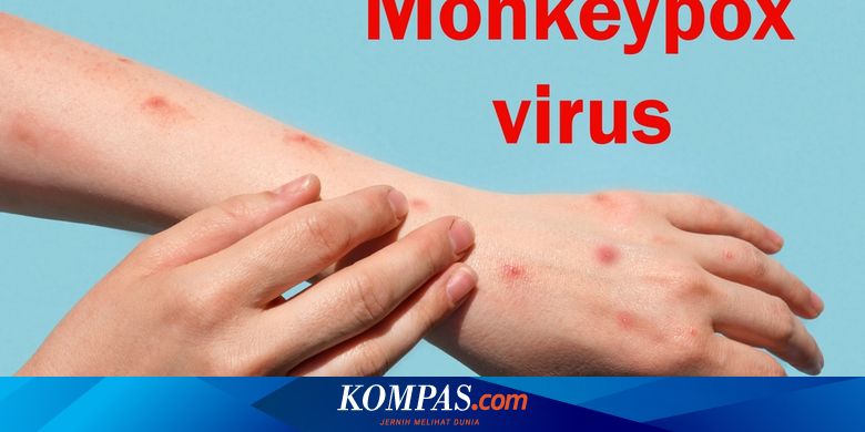 Kasus Cacar Monyet Pertama di Indonesia dan Gejalanya
