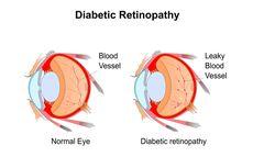 Retinopati Diabetik