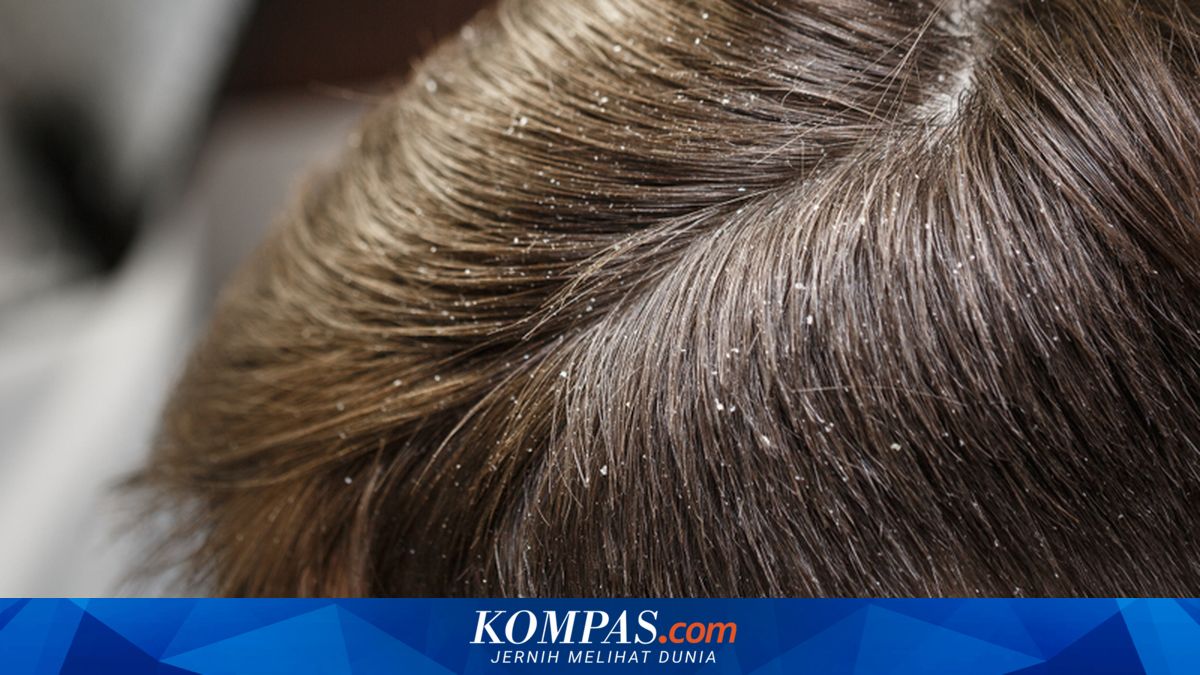 Mengenal Scalp Psoriasis dan Perbedaannya dengan Ketombe