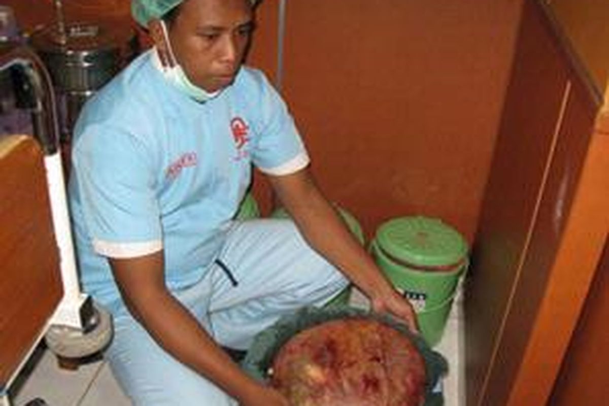 Tumor seberat 30 kilogram yang berhasil diangkat oleh tim dokter dari RS Cassa Medica, Batam. Tumor ini dikandung Sri Maryati (40) bersama anaknya. 