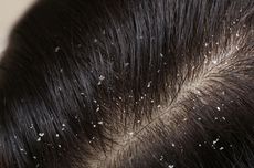 10 Obat Alami untuk Mengatasi Ketombe Rambut yang Bisa Dicoba di Rumah