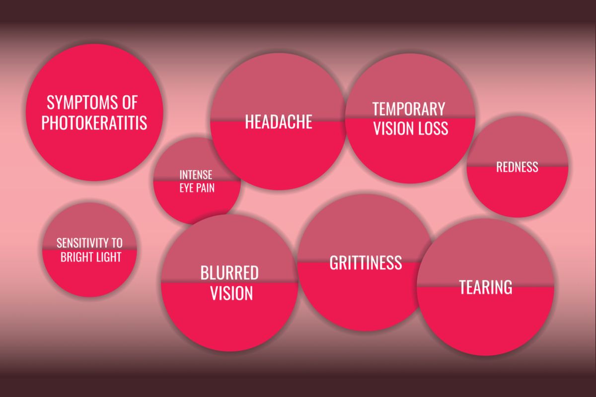 Ilustrasi fotokeratitis