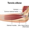 Tennis Elbow