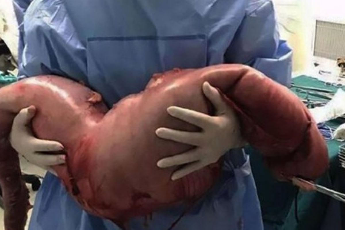 Inilah usus besar Zhou Hai yang bermasalah dan harus dipotong tim dokter RS Rakyat Ke-10, Shanghai, China, pekan lalu.