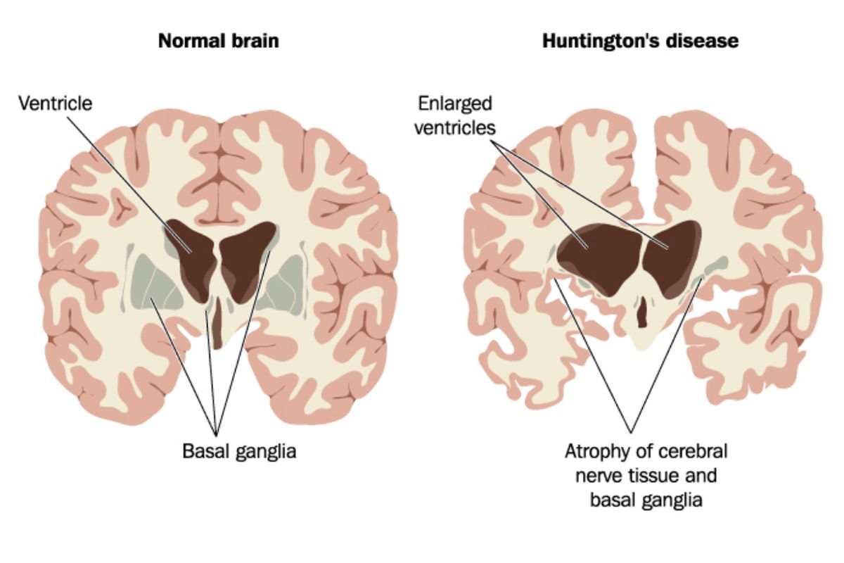 Ilustrasi penyakit huntington