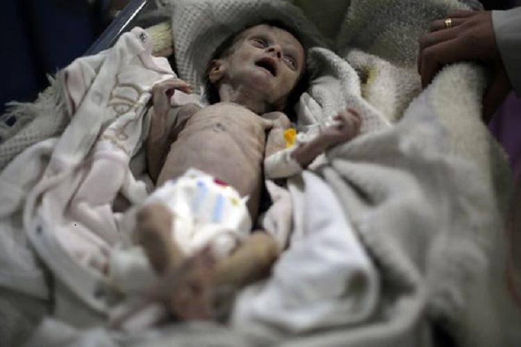 Bayi kurang gizi di Suriah ini akhirnya mati akibat kelaparan pada Minggu (22/10/2017).