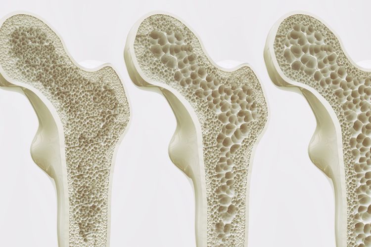 Ilustrasi Osteoporosis