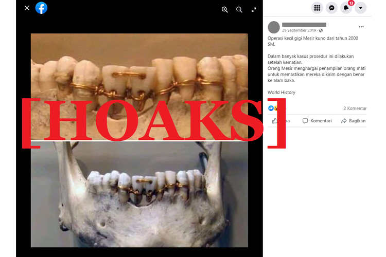 Tangkapan layar unggahan hoaks di sebuah akun Facebook, tentang foto yang diklaim sebagai kawat gigi zaman Mesir kuno 2000 SM.
