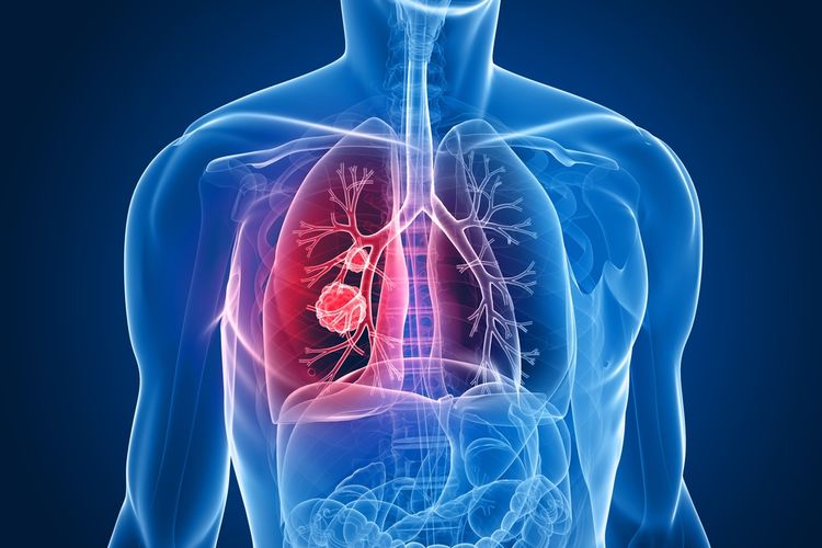 6 Cara Alami Mengatasi Rasa Sakit Akibat Kanker Paru-paru