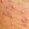 Folikulitis