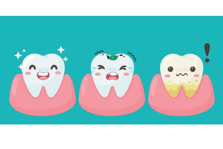 Ilustrasi gigi sehat, gigi karies, dan gigi dengan plak.