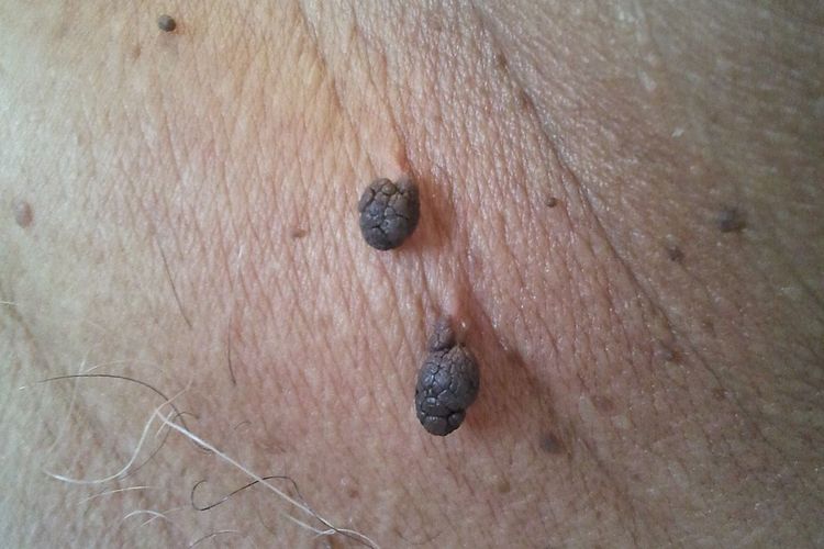 skin tag