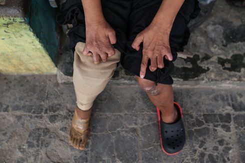 Indonesia Negara Penderita Kusta Terbanyak Ketiga di Dunia
