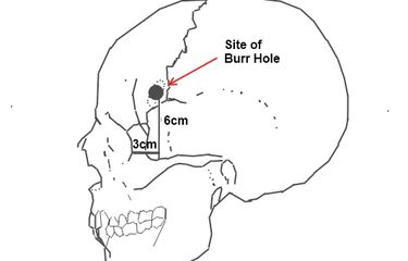 Site of borehole for the standard pre-frontal lobotomy/leucotomy operation as developed by Freeman and Watts