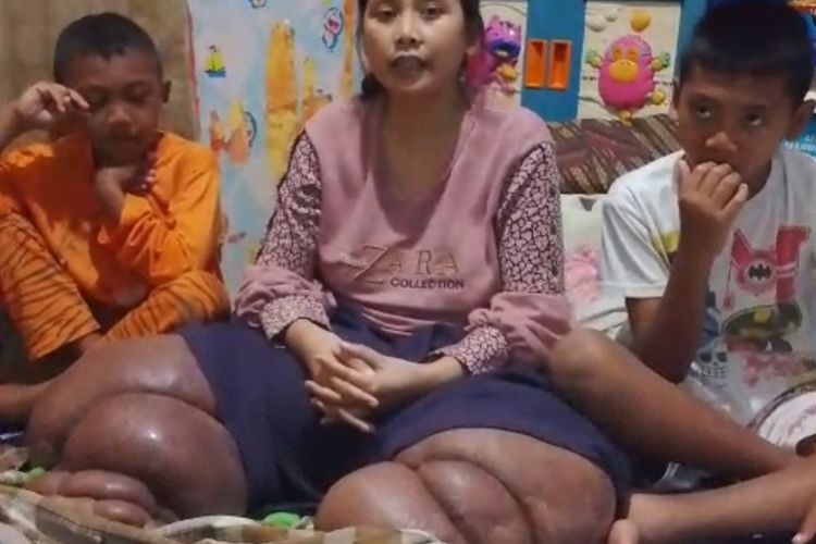Misri (35) Eks Pekerja Migran Bahrain Warga Desa Sende Kecamatan Arjawinangun Kabupaten Cirebon Jawa Barat memberikan keterangan terkait sakit kaki gajah yang dialaminya yang viral di media sosial pada Selasa (22/9/2025) siang.