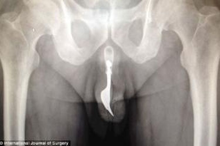 Seorang pria usia 70 tahun di Australia memasukan garpu baja ke dalam penisnya dalam upaya untuk memuaskan dirinya. Garpu itu kemudian tidak bisa dikeluarkan dan dia harus mencari pertolongan medis untuk mengeluarkannya.